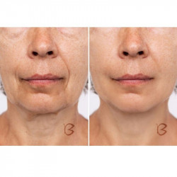 Beautifly B-Glossy Blush μη επεμβατική συσκευή μεσοθεραπείας, Διέγερση του κυτταρικού μεταβολισμού, Φωτοθεραπεία και ιονοθεραπεία, Μειώνει τις ρυτίδες και τα σημάδια ακμής, Ροζ