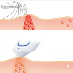 Beurer BR10 Mosquito Bite Treatment Device, Suitable for pregnant women and children, 300 applications, Chemical-free, Topical application, White