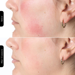 Masca fototerapeutica pentru fata Silk'n LED Face Mask 100 FLM100PE1001, Аutonomie de 130 de minute, 4 moduri, Sesiune de 10 minute, Design flexibil, Alb