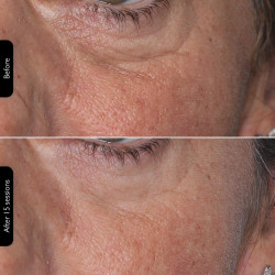 Φωτοθεραπευτική μάσκα προσώπου Silk'n LED Face Mask 100 FLM100PE1001, Αυτονομία 130 λεπτών, 4 λειτουργίες, Συνεδρία 10 λεπτών, Ευέλικτος σχεδιασμός, Λευκό